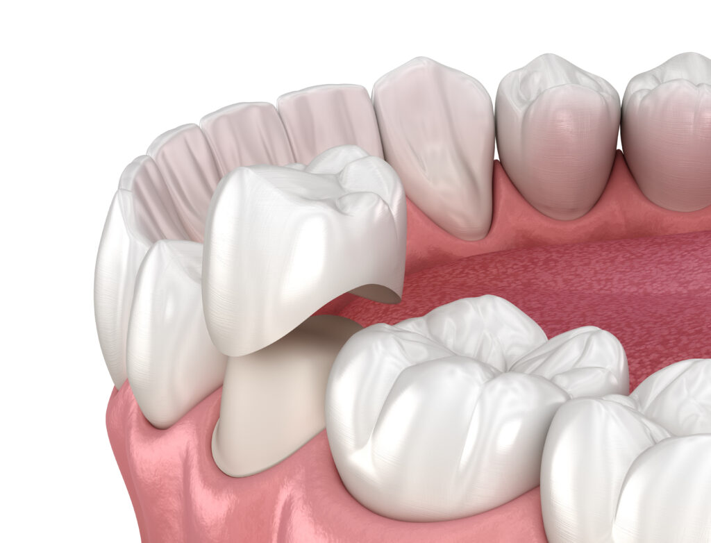 rochester dental crowns