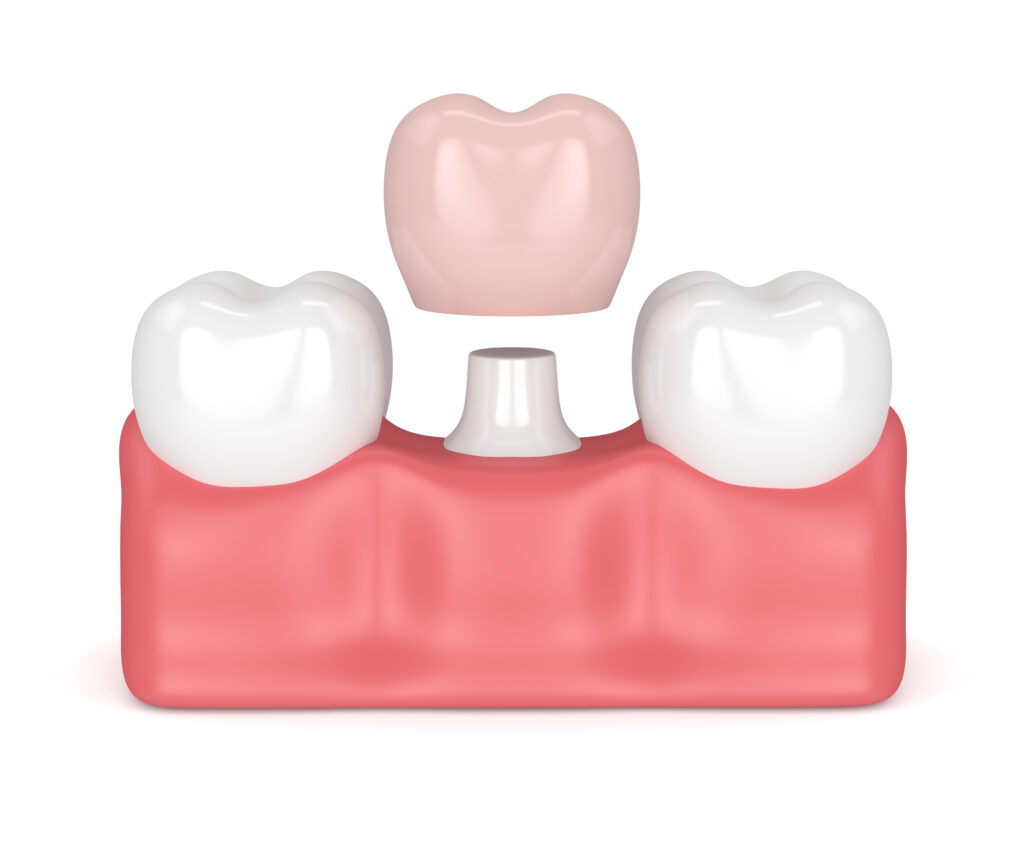 rochester dental crowns