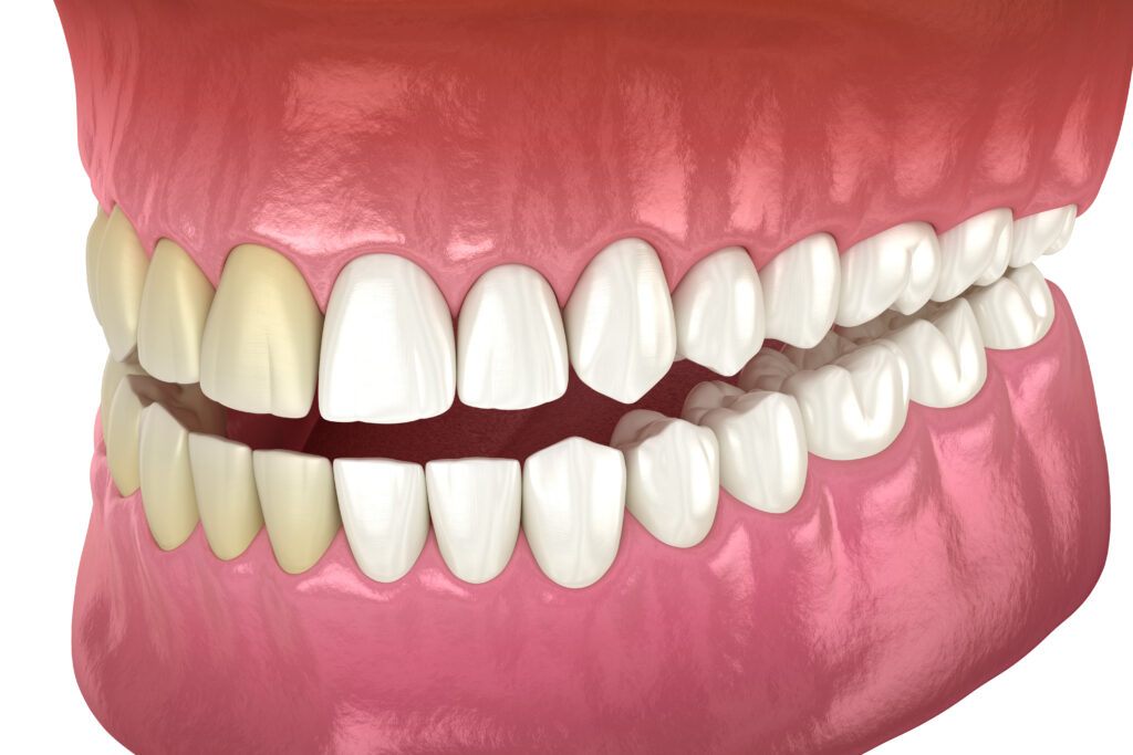 rochester teeth whitening