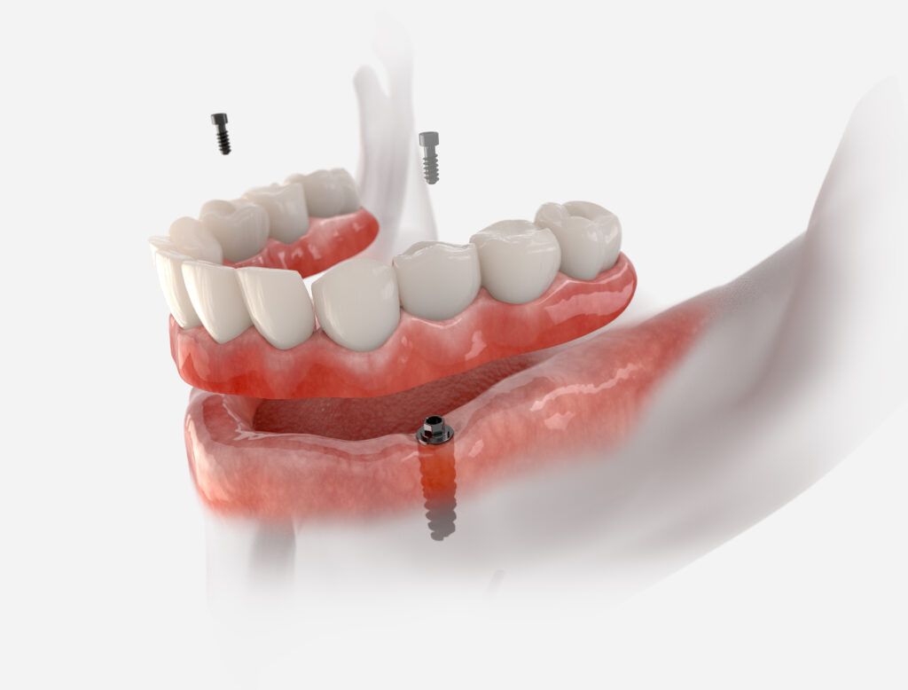 rochester implant dentures