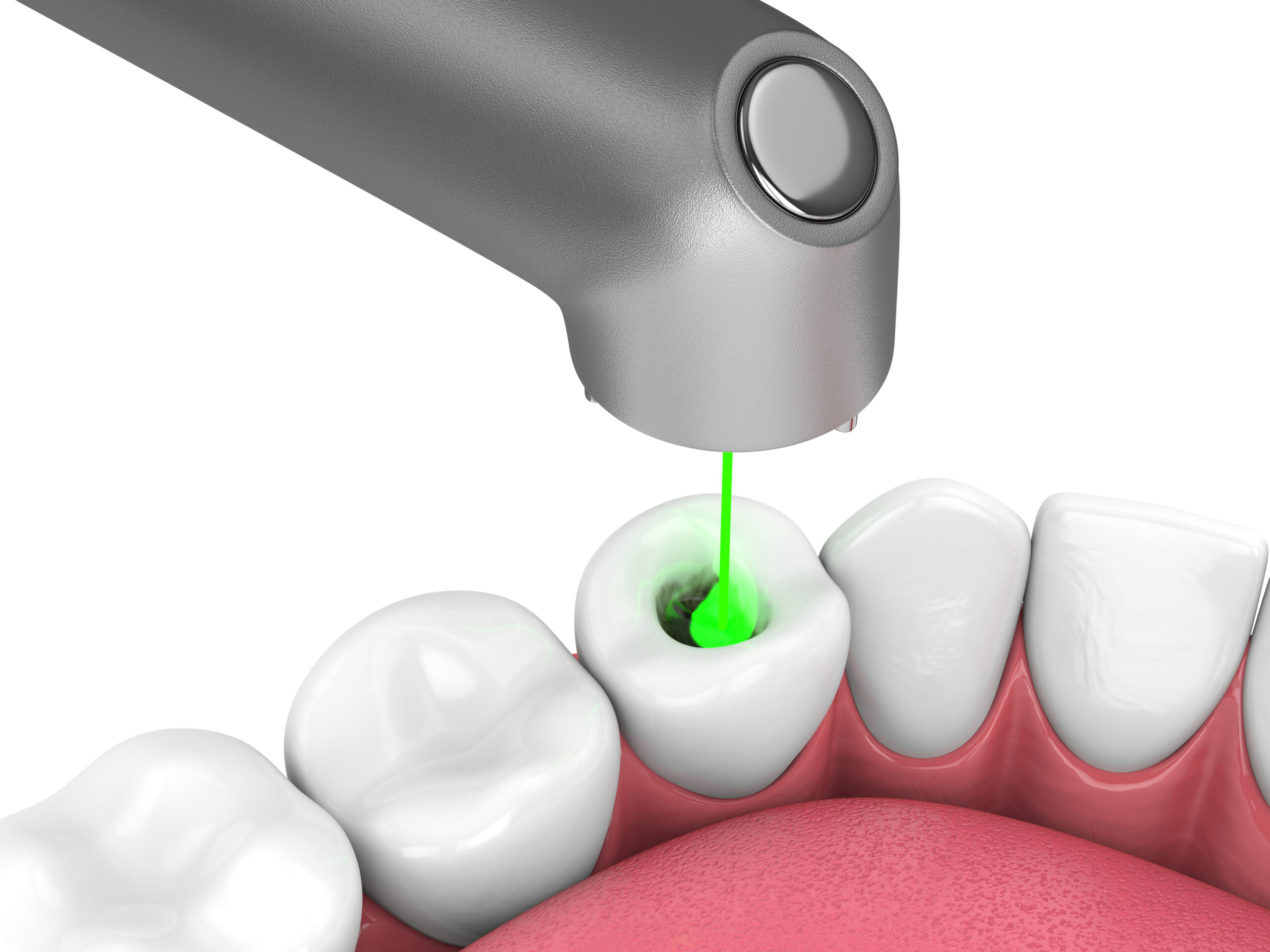 Dental Lasers Mean Treatment With Comfort Rochester, MN