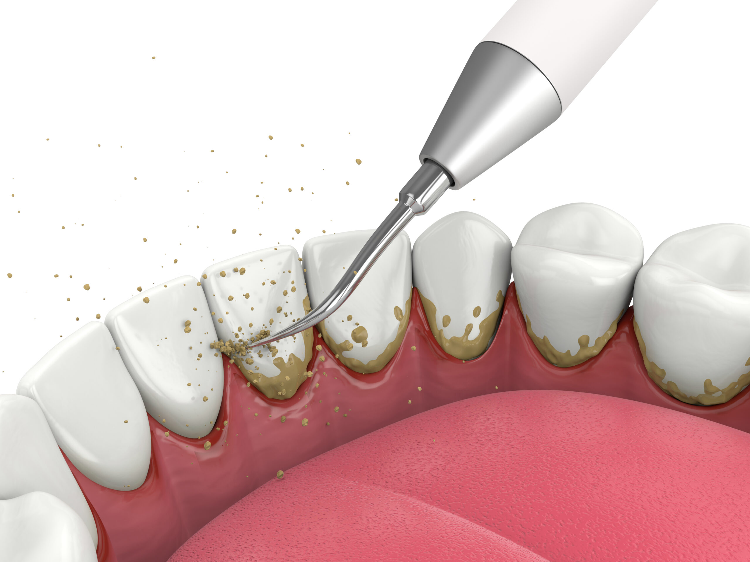 how-to-keep-your-gums-free-of-disease-rochester-mn