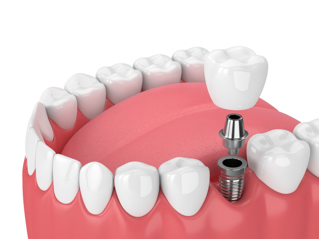 rochester dental implants