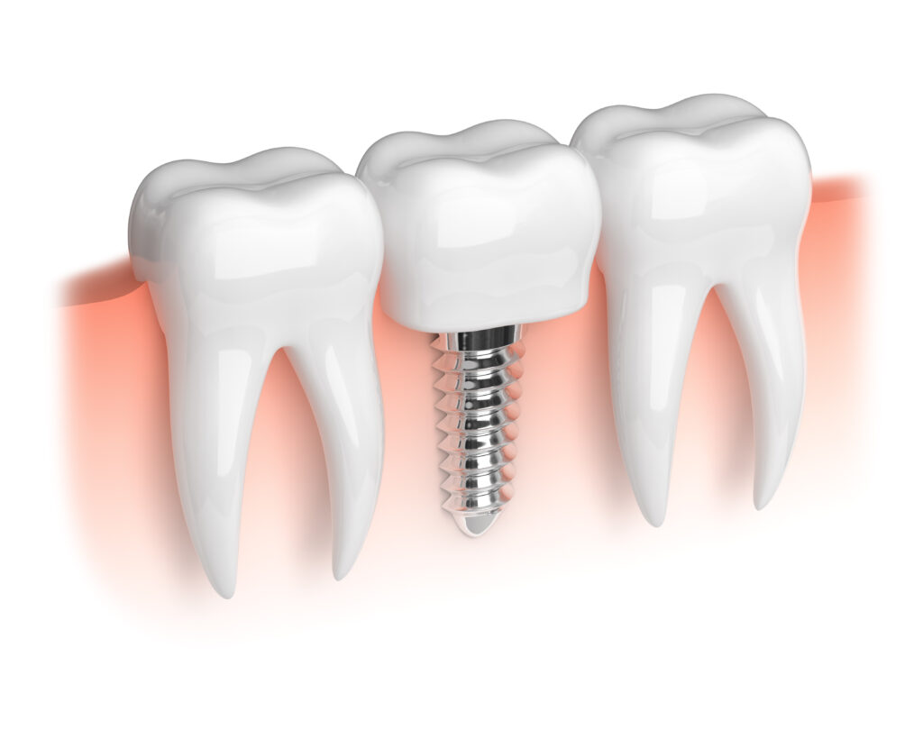 rochester dental implants