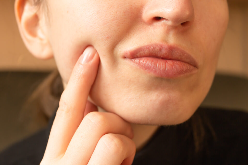 Treat Your Cold Sores at Greenview Dentistry