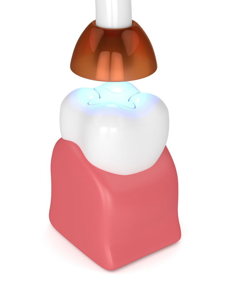 rochester dental fillings
